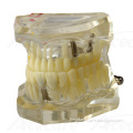 Dental Implant Model with Restoration AC-P6